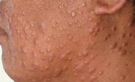 Dünya Cüzzam (Lepra) Günü