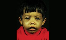 Talasemi Hasta Kılavuzu 2