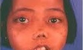 Talasemi Hasta Kılavuzu 1